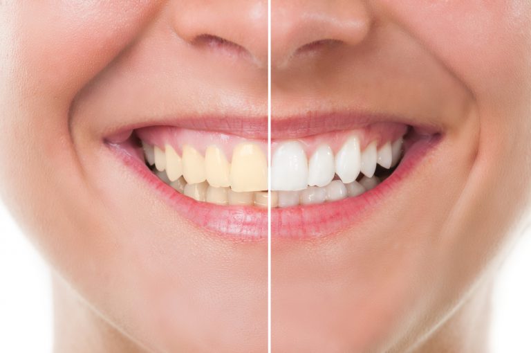Amazing Facts About Teeth Whitening That You Must Know