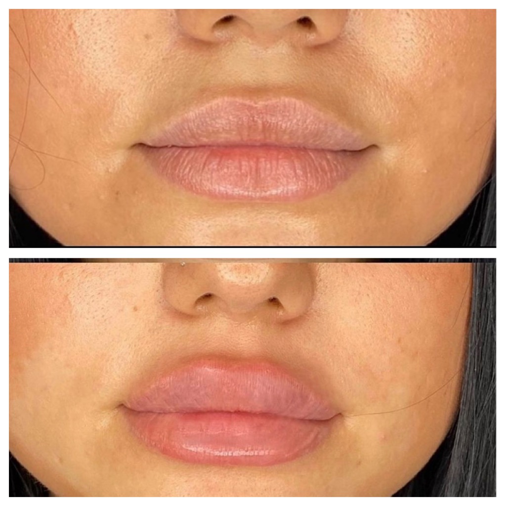 lip filler brisbane