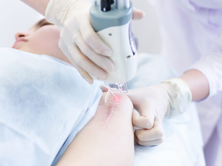 pigmentation removal macquarie park